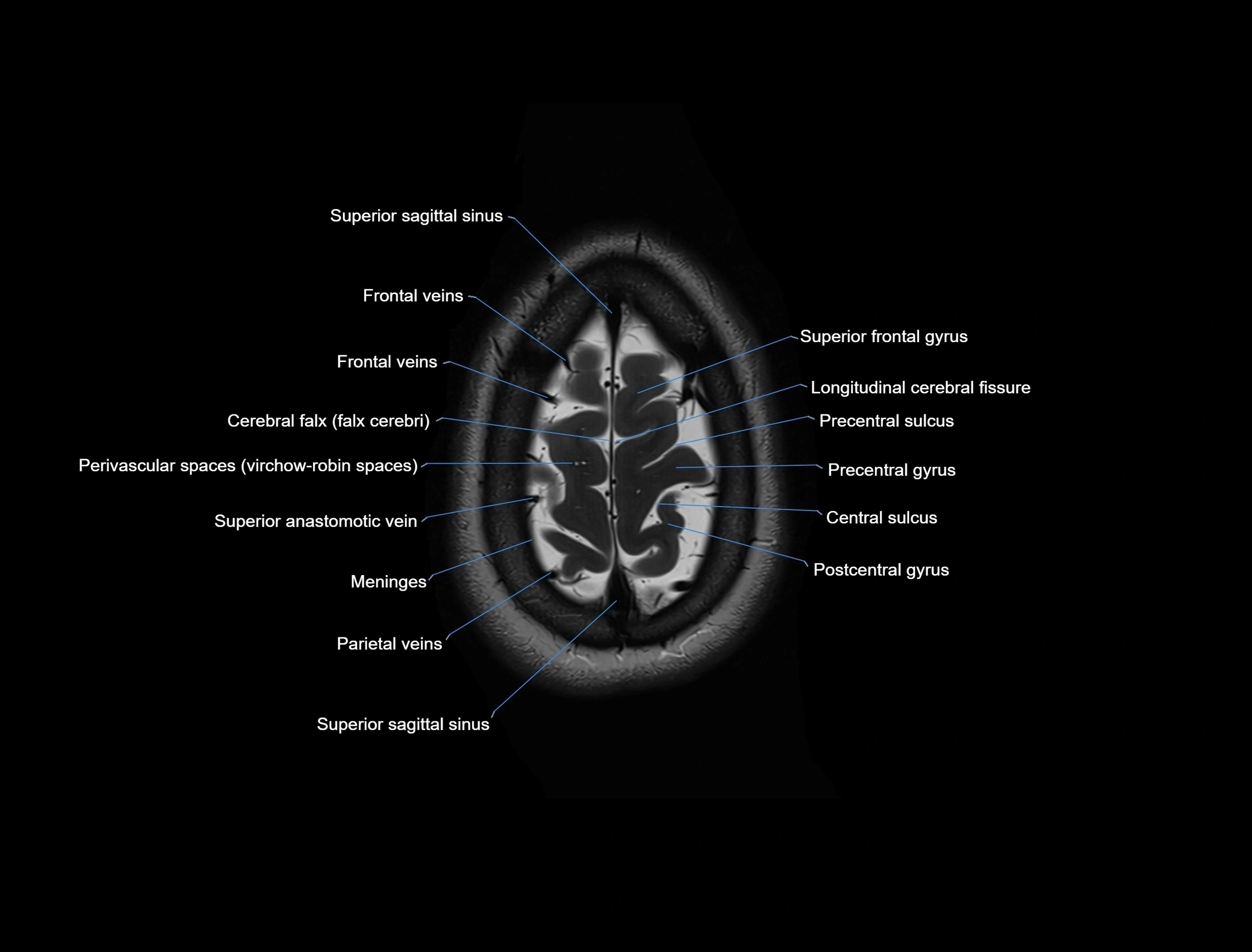 MRI Brain axial cross sectional radiology anatomy 3T image  -img-00001-00055.webp
